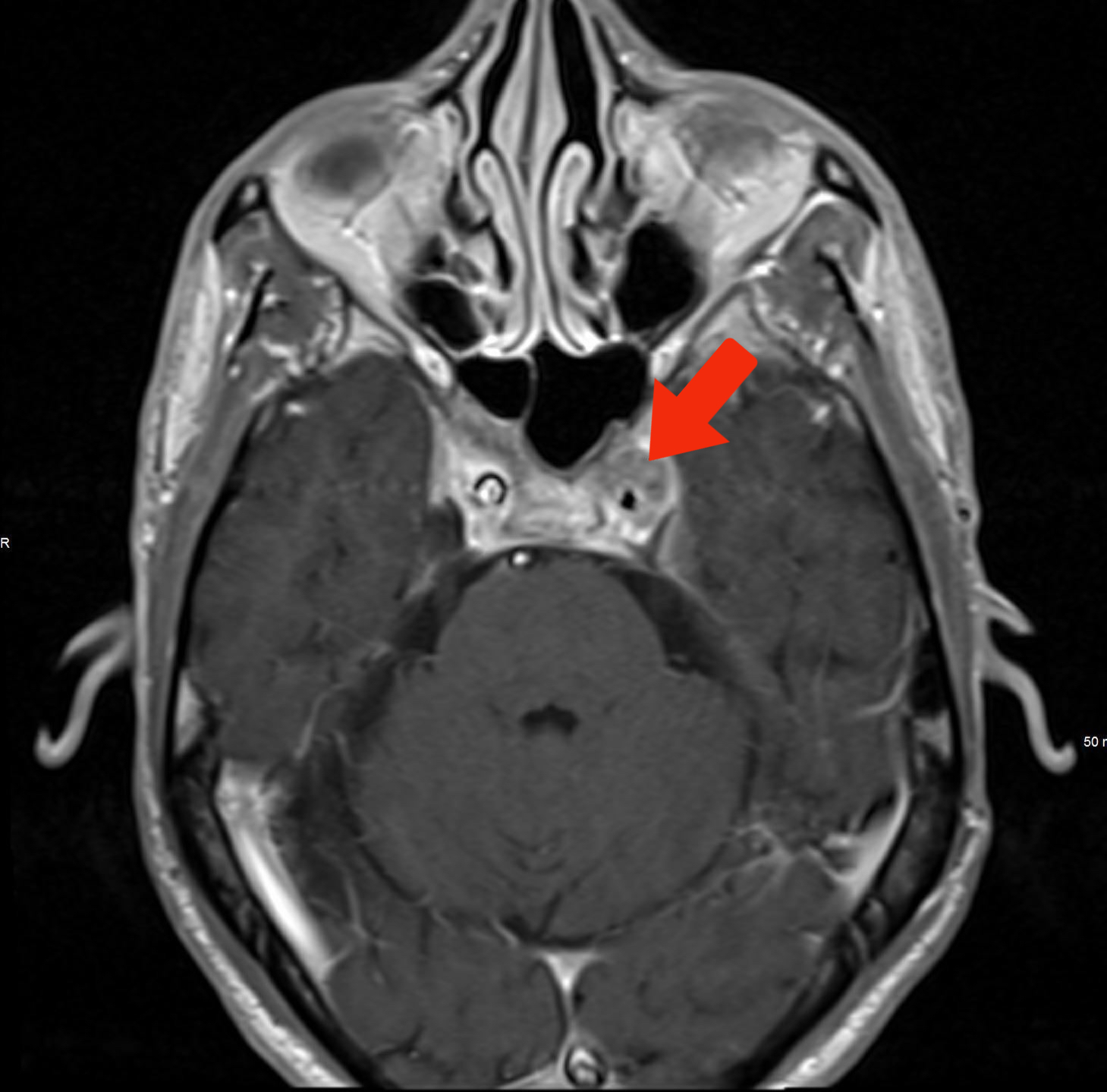 Nasopharyngeal Carcinoma Presenting as Third Nerve Palsy Consultant360